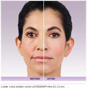 Facial Fillers Cost 9