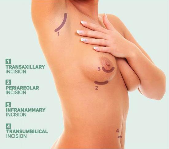 Transaxillary Breast Augmentation