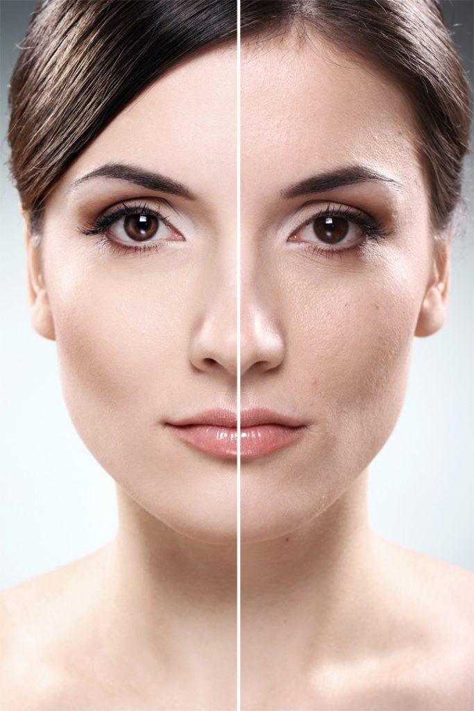 Laser Skin Resurfacing