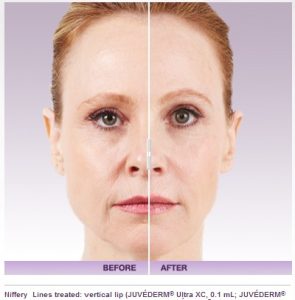 Dermal Fillers