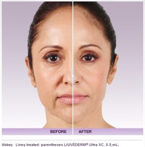 How Long Does Juvederm Last | Hunstville | Cosmetic Surgeon