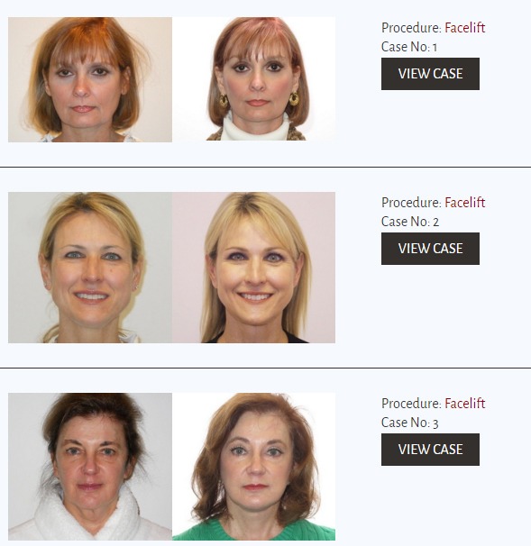 Facelift Plastic Surgery