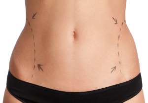 Tummy Tuck vs Liposuction: Which is Right for You? | Huntsville