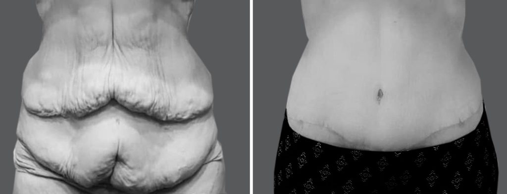 Apronectomy To Remove Loose Tummy Skin