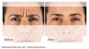Botox vs. Xeomin to Smooth Out Wrinkles