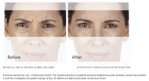 Xeomin Injections Before And After Photos