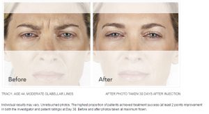 Xeomin Injections To Get Rid Of Wrinkles